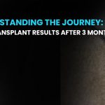 Hair Transplant Results After 3 Months