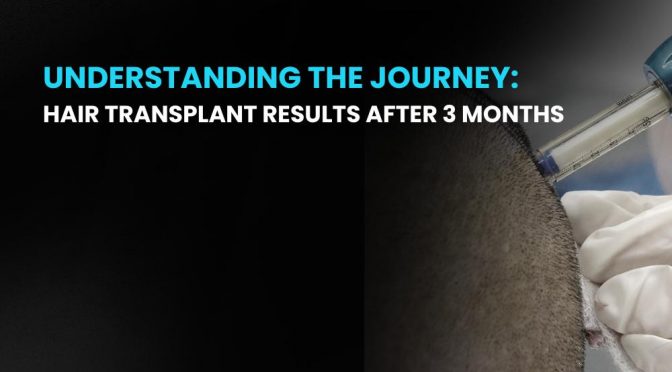 Hair Transplant Results After 3 Months