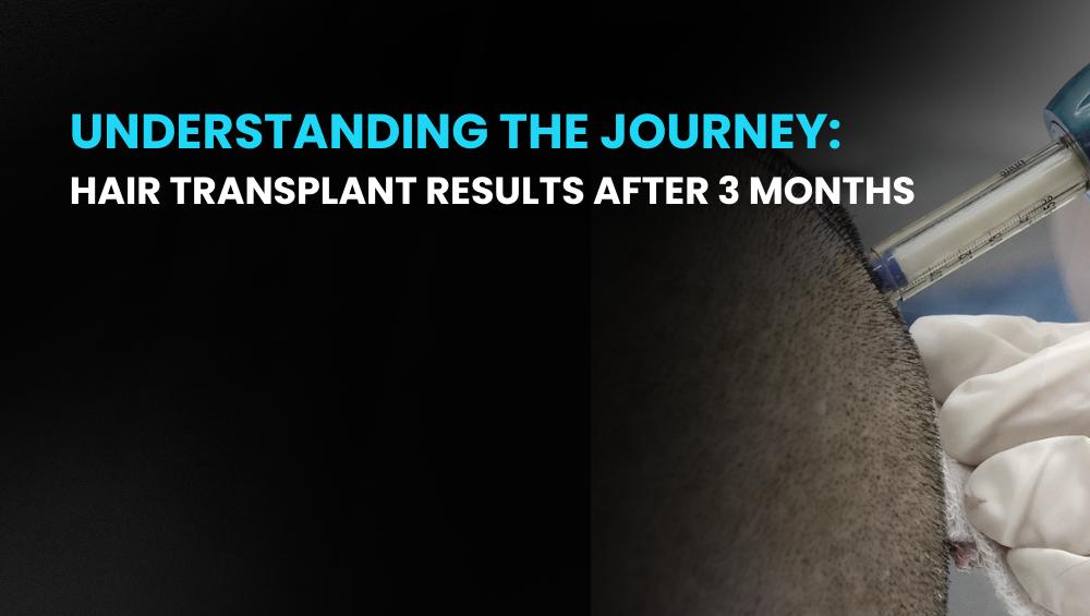 Hair Transplant Results After 3 Months