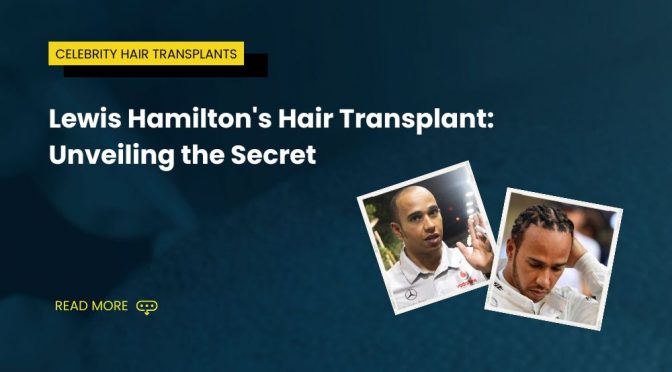 Lewis Hamiltons Hair Transplant 