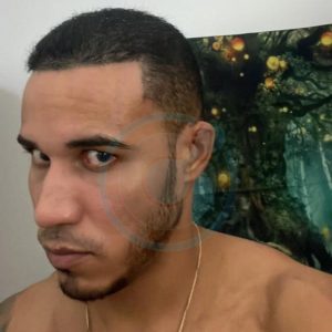 Hector Acosta hair transplant