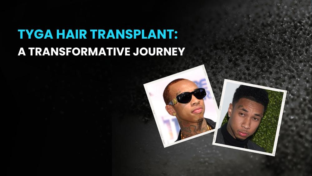 Tyga Hair Transplant 1