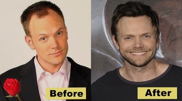joel mchale before and after hair transplant