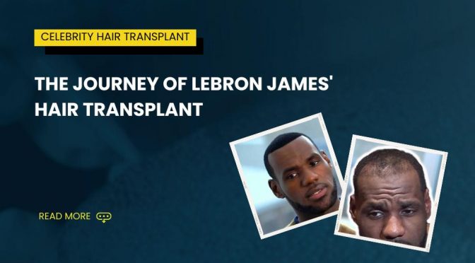 LeBron James Hair Transplant