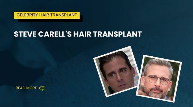 The Story Behind Steve Carell’s Hair Transplant