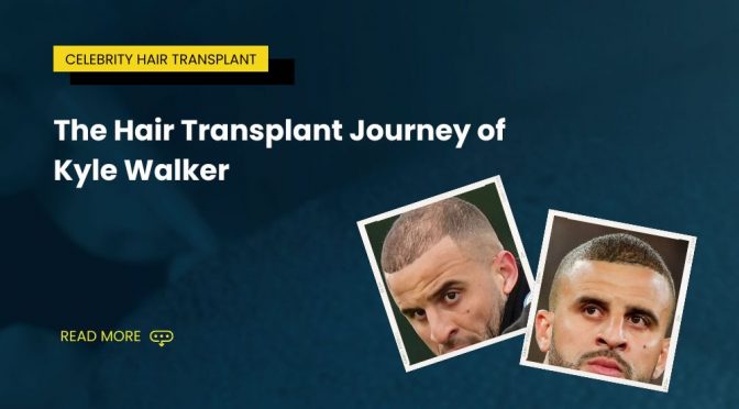 The Hair Transplant Journey of Kyle Walker