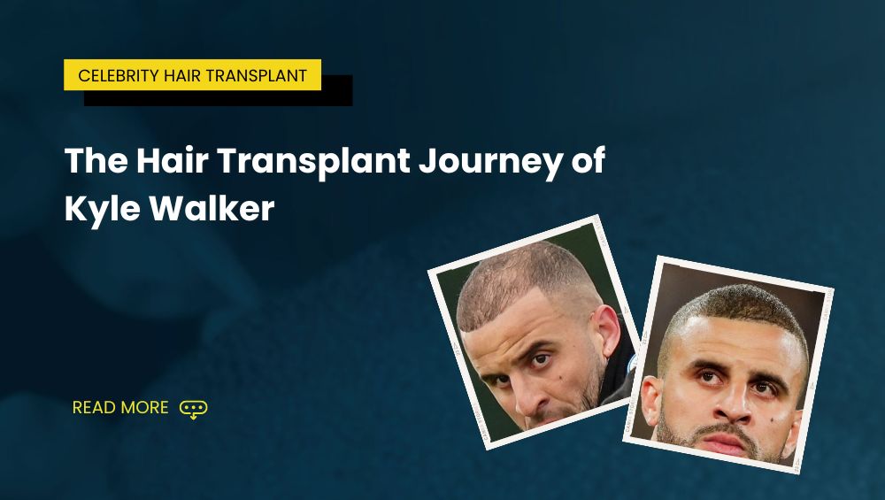 The Hair Transplant Journey of Kyle Walker