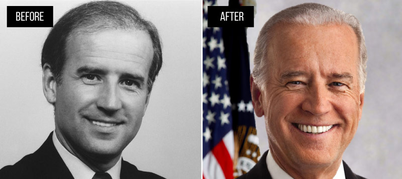 joe biden hair transplant