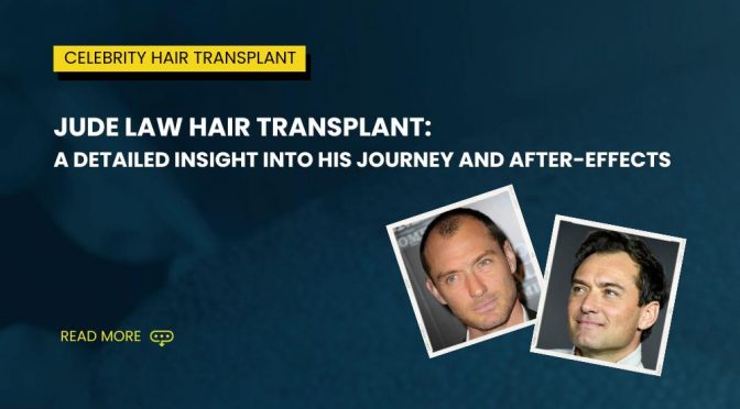 Jude Law Hair Transplant A Detailed Insight into His Journey and After effects