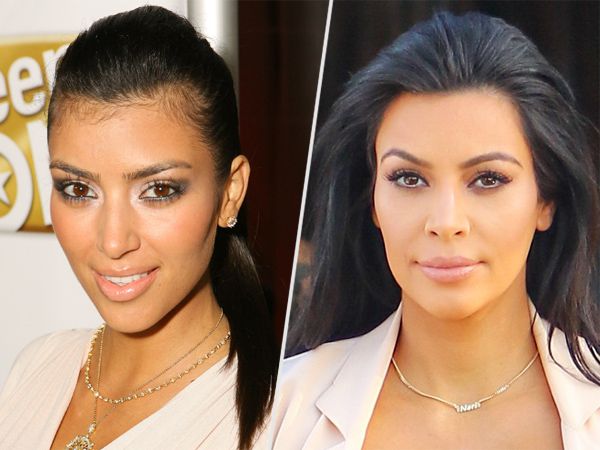 KIM KARDASHIAN hairline before and after hair transplant