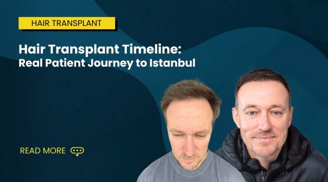 Hair Transplant Timeline: Real Patient Journey to Istanbul