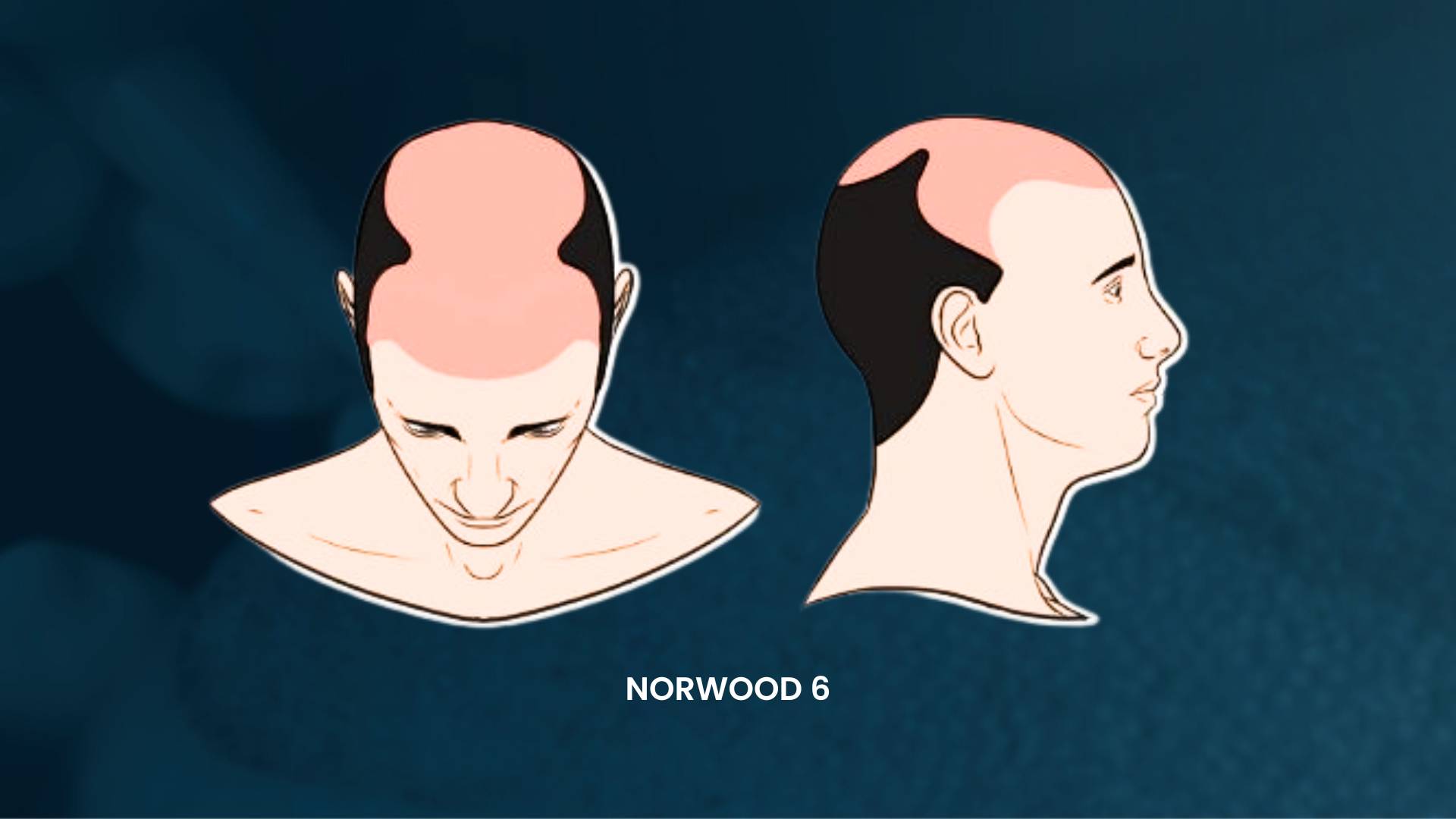 Norwood 6 hair loss scale