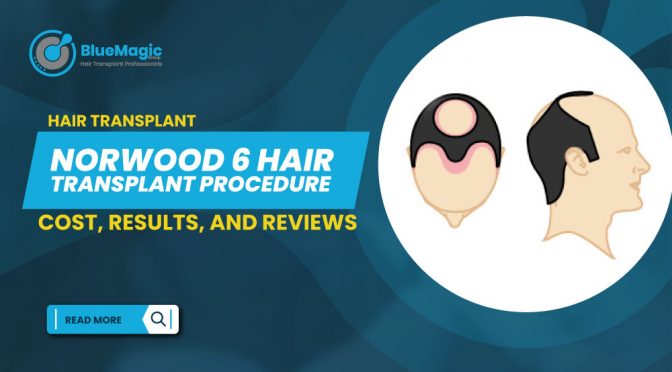 Norwood 6 Hair Transplant Procedure Costs Results and Reviews
