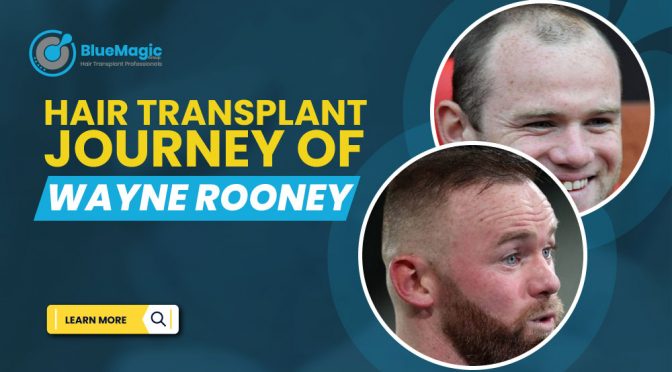 Wayne Rooney’s Hair Transplant Journey