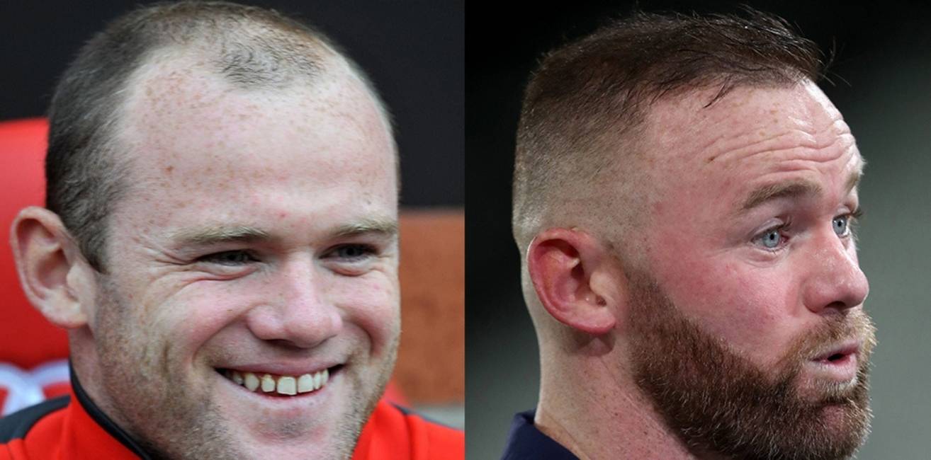 Wayne Rooney Before and After Hair Transplant