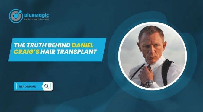 The Truth Behind Daniel Craigs Hair Transplant