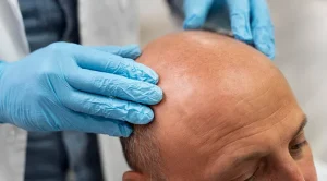 Image from BlueMagic Group’s blog showing a patient undergoing a detailed consultation for a personalized hair transplant plan.