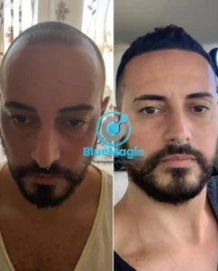 Side-by-side comparison showing a patient’s transformation after undergoing a successful hair transplant at BlueMagic Group