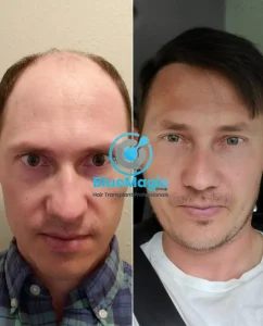Side-by-side comparison of a patient’s hairline before and after a successful transplant at BlueMagic Group, highlighting restored density and natural appearance.