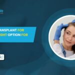 Is FUE Hair Transplant for Women the Right Option for You