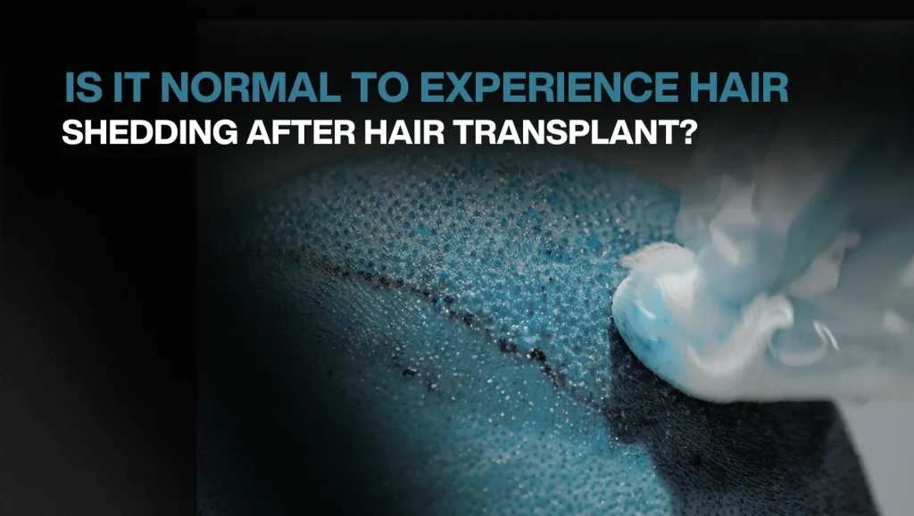 Is It Normal To Experience Hair Shedding After Hair Transplant