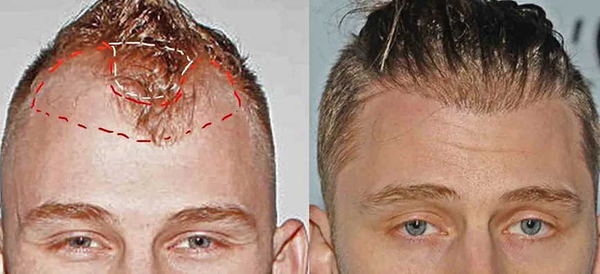 MGK hair transplant