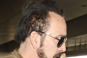 Nicolas Cage Hair Transplant