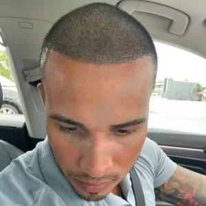 Hector Acosta hair transplant