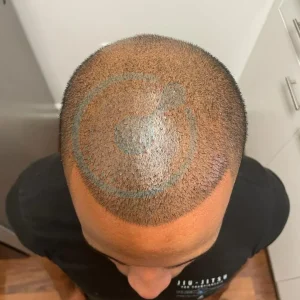 BlueMagic Group Clinic Hair transplant