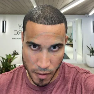 Hector Acosta hair transplant