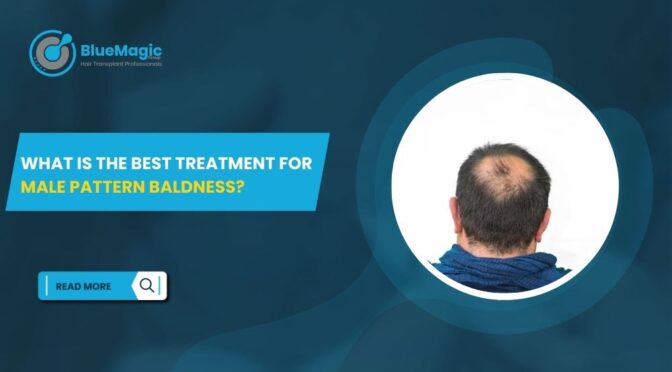 What Is the Best Treatment for Male Pattern Baldness