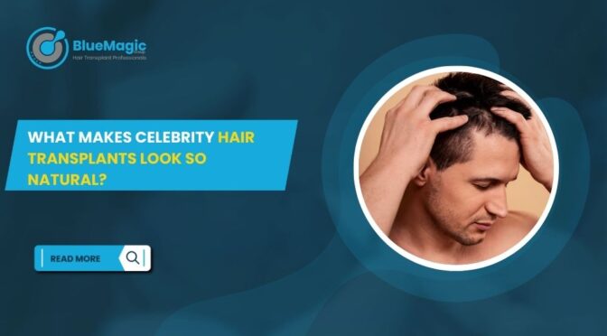 What Makes Celebrity Hair Transplants Look So Natural