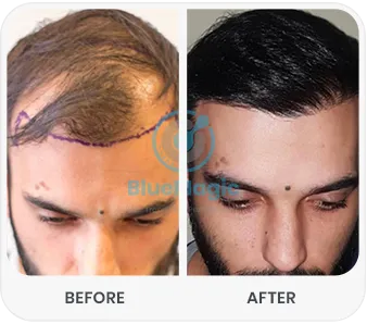 Before and after comparison of hair transplant results showcasing significant improvement in hair density at BlueMagic Clinic
