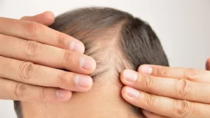 Patient testimonial image showcasing their satisfaction with the results of their hair transplant procedure at BlueMagic Group.