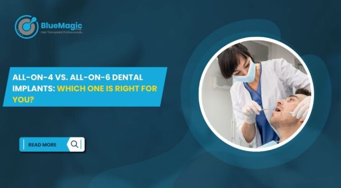 All-on-4 vs. All-on-6 Dental Implants Which One Is Right for You