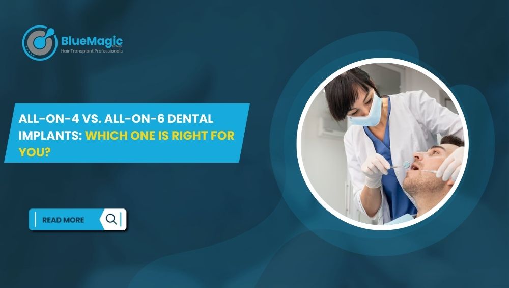 All-on-4 vs. All-on-6 Dental Implants Which One Is Right for You