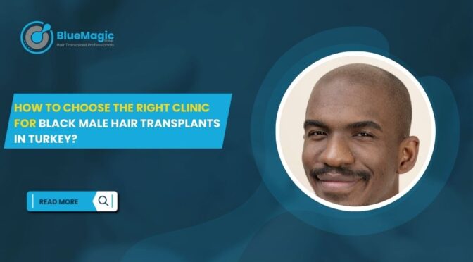 How to Choose the Right Clinic for Black Male Hair Transplants in Turkey