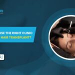 How to Choose the Right Clinic for Eyebrow Hair Transplant