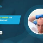 Why Celebrities Prefer the Sapphire Method Hair Transplant
