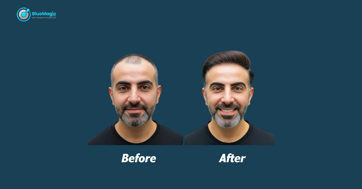 Best Hair transplant in Turkey 