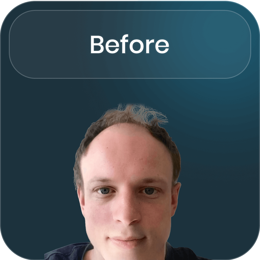 Illustration of the first step in the hair transplantation process at BlueMagic Group, focusing on initial consultation and personalized planning.