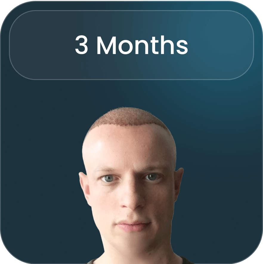 Image highlighting the preparation stage of a hair transplant procedure at BlueMagic Group, emphasizing precision and care
