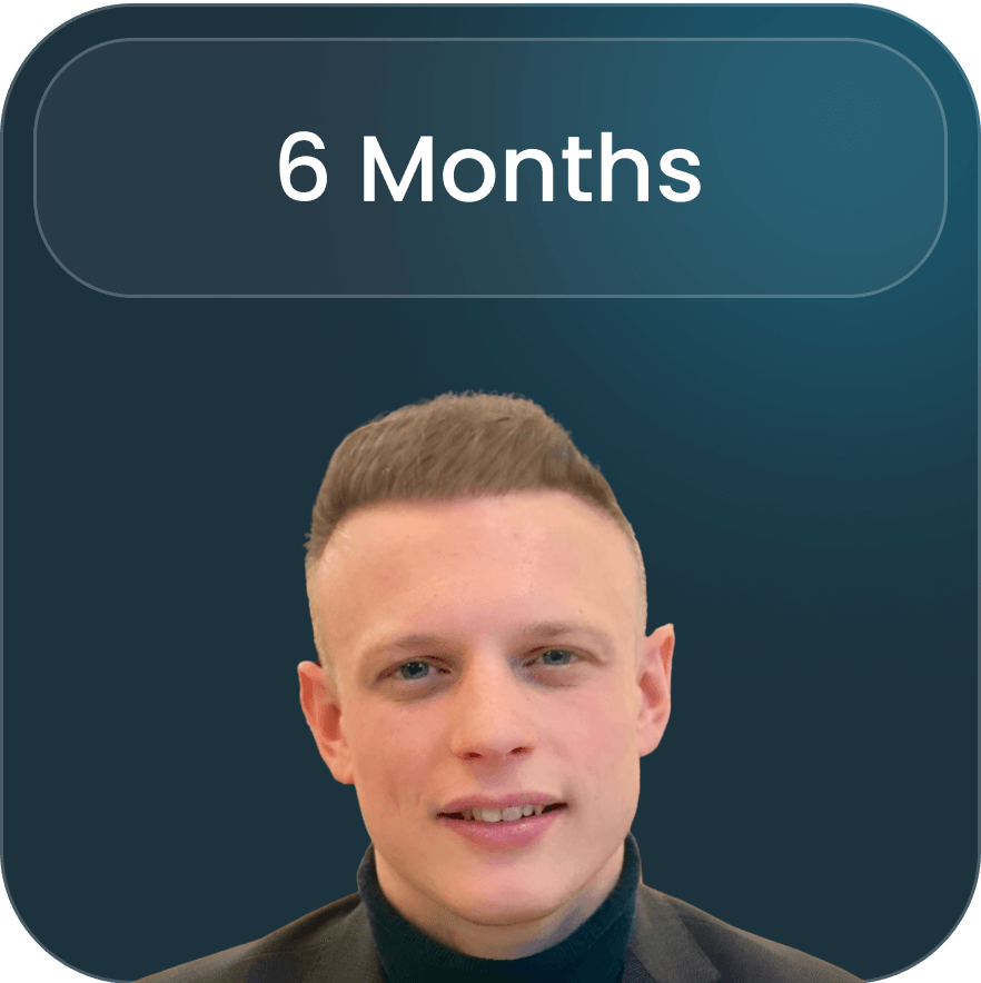 Illustration of the surgical stage of a hair transplant procedure at BlueMagic Group, highlighting precision and care during follicle implantation.