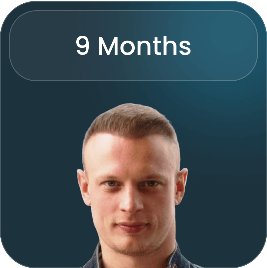 Image detailing post-operative care and recovery following a hair transplant at BlueMagic Group, emphasizing the importance of follow-up consultations.