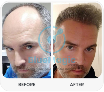 Side-by-side comparison image showing the results of a hair transplant procedure. The left side displays the 'Before' condition with visible thinning or baldness at the hairline, while the right side shows the 'After' condition with fuller, thicker hair growth at the same area.