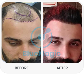 Side-by-side view of a hair transplant procedure. The left side shows the scalp marked with guidelines before transplantation, highlighting the area to be treated, and the right side shows the 'After' image with newly transplanted hair follicles and visible improvement in density.