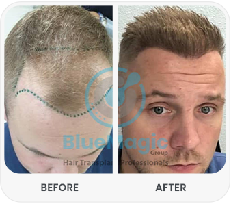 Before and after comparison of a hair transplant procedure at Bluemagic Clinic, showing improved hair density and a natural-looking hairline.