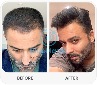 Comparison of before and after a hair transplant procedure at Bluemagic Clinic, highlighting fuller and healthier hair in the after image.