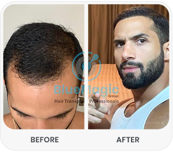 Before and after comparison of a successful hair transplant procedure performed by BlueMagic Group. The left side shows thinning hair and bald patches, while the right side displays a fuller, natural-looking head of hair post-transplant