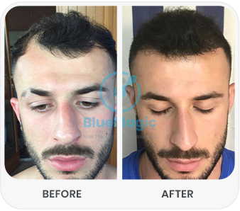 Before and after comparison of a hair transplant procedure. The 'before' image shows significant hair thinning at the front and top of the scalp, while the 'after' image displays a fuller and denser hairline with improved hair coverage, highlighting the results of the procedure.